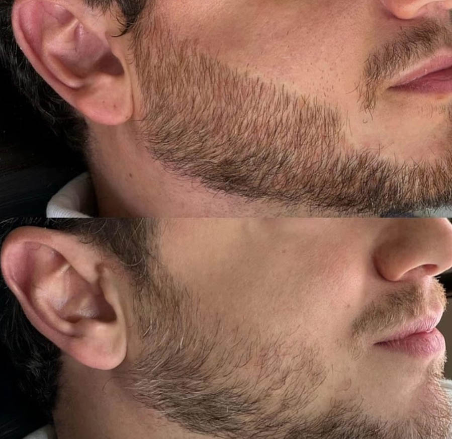 Camuflagem de Barba em Santos Camuflagem de Barba em Santos | São Vicente | Guarujá | Vivi Valente Estética